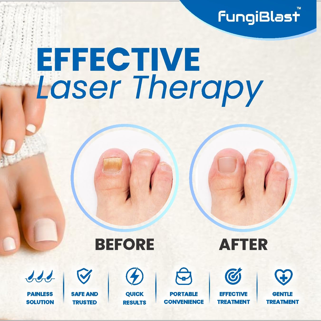 FungiBlast Nail Fungus Laser Treatment Device - Onychomycosis Laser Nail Treatment - Effective | Safe | Rechargeable home Laser Treatment for Damaged Discolored Unattractive Nails